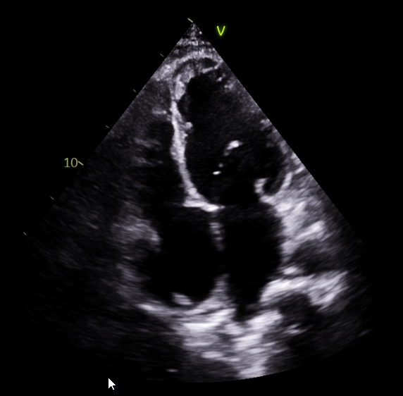 Apical four-chamber echocardiographic view from the case report